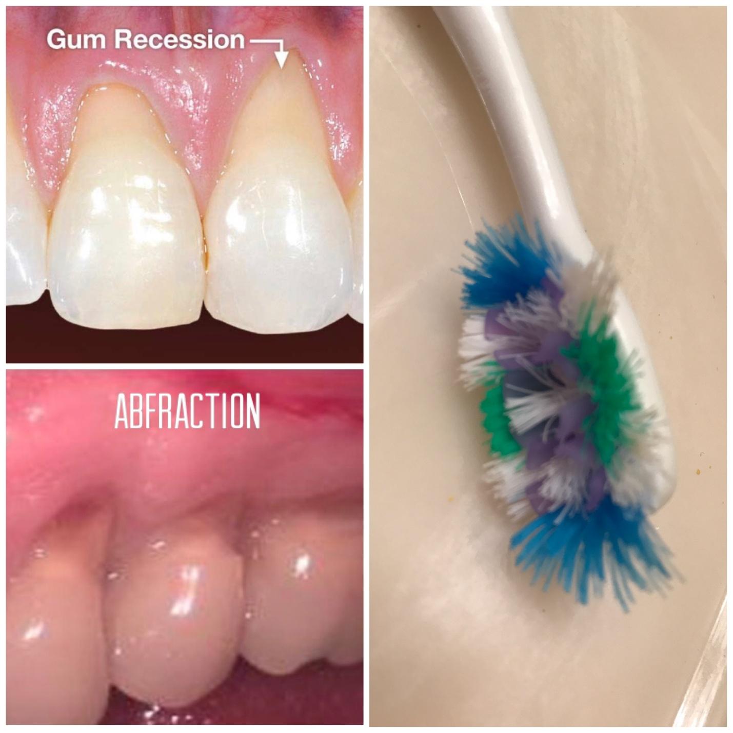 Brushing too hard image 1