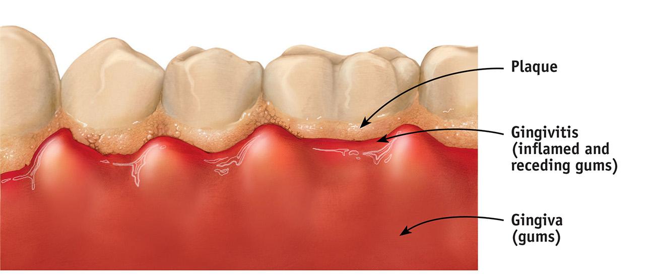 Ignoring the gumline image 2